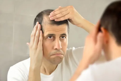 Mand ønsker at behandle alopecia naturligt