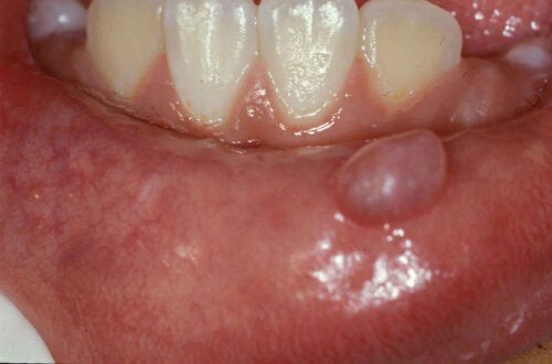 Orale slimhindecyster: Årsager, symptomer og behandling