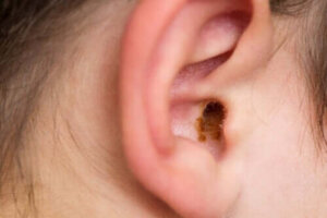 Karakteristika ved cerumen impactum