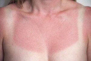 4 naturlige midler mod solskoldning