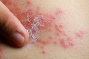 Kan man behandle psoriasis med traditionel kinesisk medicin?