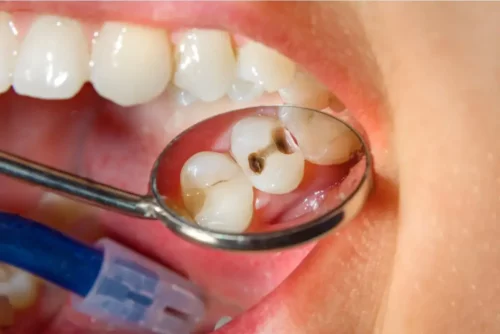 Huller i tænder viser forholdet mellem mundhygiejne og inflammatorisk tarmsygdom