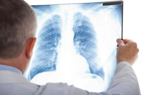 Lungeemboli: Symptomer og behandling