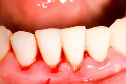 Blødende tandkød kan være tegn på behov for curettage