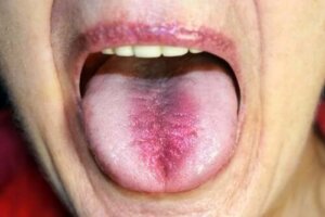 Brændende mund syndrom: Identifikation og behandling