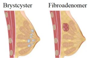 Hvordan kan jeg forebygge brystcyster?