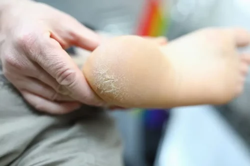 Hård hud på hæl kan plejes med et fodbad derhjemme