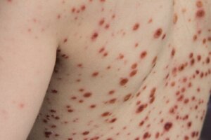 Abekopper: Årsager, symptomer, diagnose og behandling