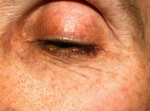 Farvede pletter på øjenlågene: Hvorfor opstår de?