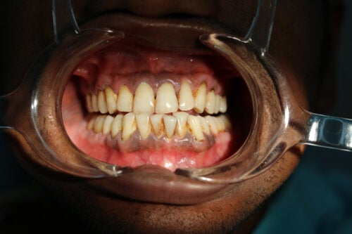 Sorte pletter på tandkødet: Årsager og behandlinger