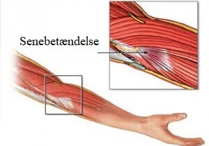 Illustration af senebetændelse