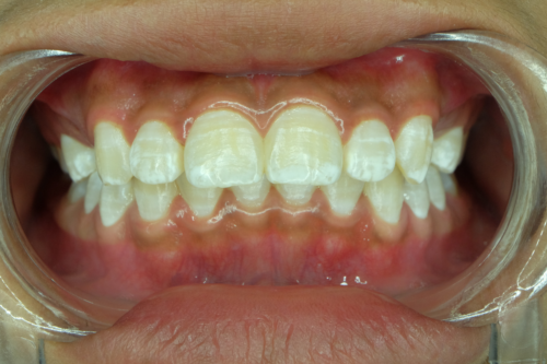 Hvide pletter på tænderne: Hvorfor opstår de?