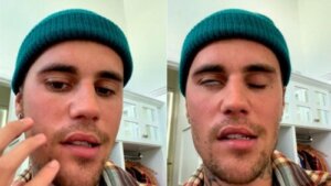 Justin Biebers Ramsay Hunts syndrom: Hvad er denne sygdom?
