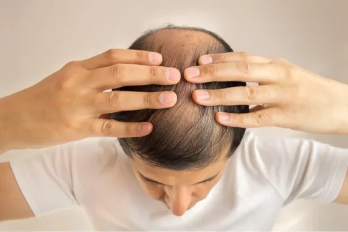 Mand med alopecia grundet dihydrotestosteron