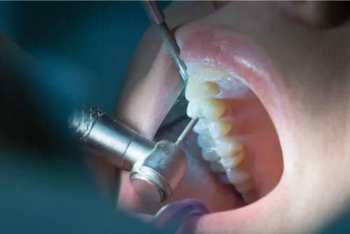 En tand undersøges
