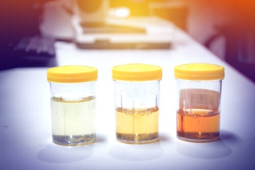 Grumset eller mørk urin: 11 mulige årsager og deres behandling