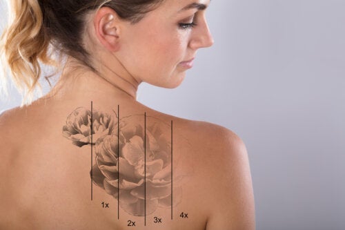 Hvad er risiciene ved at fjerne tatoveringer med laser?