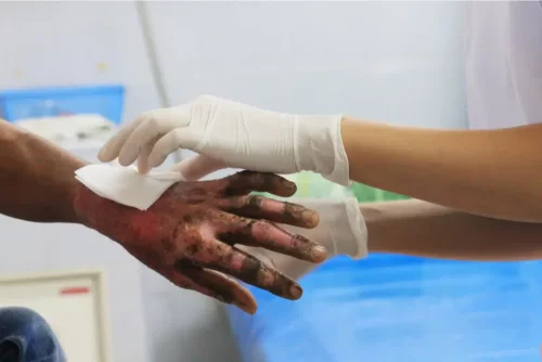 Alvorlig forbrænding på hånd kan kræve hudtransplantation