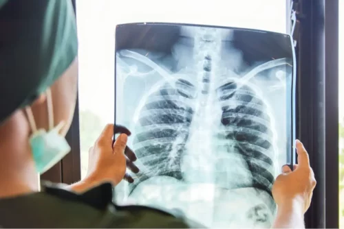 Røntgen viser en plet på lungen