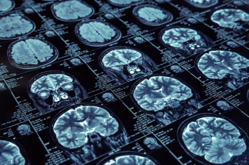 Scanning af hjerne for at diagnosticere Alzheimers sygdom