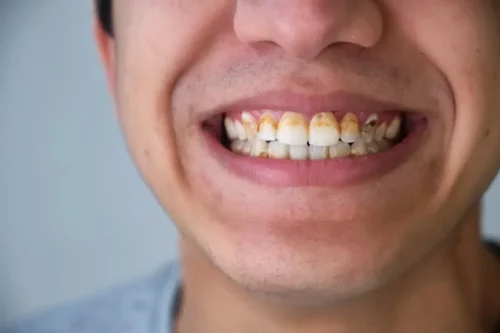 Tandsten som følge af bakteriel tandplak