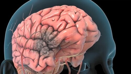 Blodprop i hjernearterier: Hvad det er, årsager, symptomer og behandling