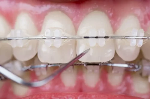 Nærbillede af tænder med bøjle på