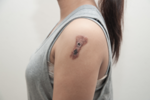 Pladecellekræft: Årsager, symptomer og behandlinger