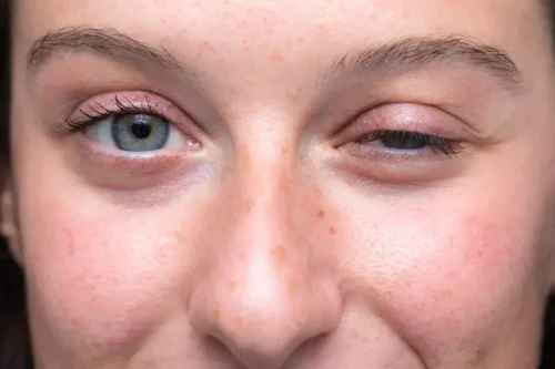 Kvinde med dovent øje som eksempel på gængse øjenlågslidelser