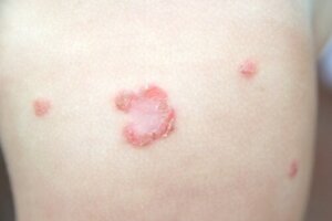 Impetigo hos børn
