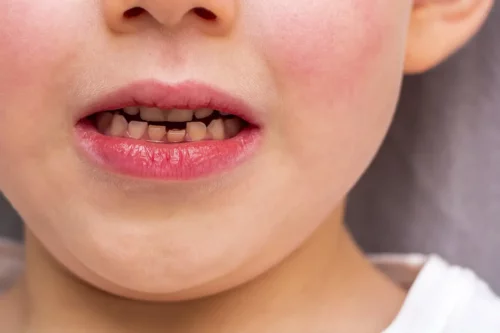 Barn med skæve tænder grundet amelogenesis imperfecta