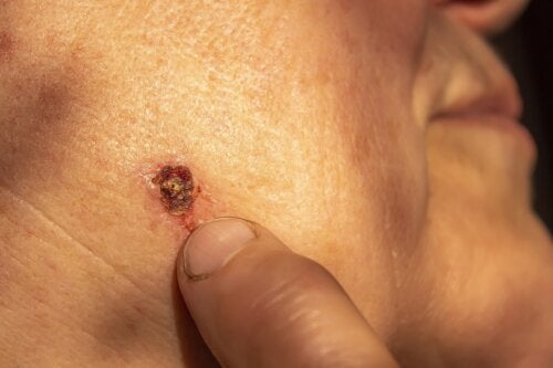 Basalcellekarcinom: Den mest almindelige type hudkræft