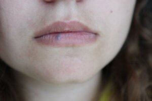 Læbekræft: Årsager, symptomer og behandlinger