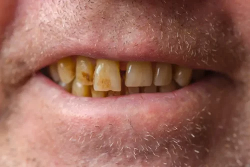 Mand med plettede tænder har brug for en tandrensning med ultralyd
