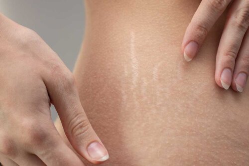 Strækmærker på kvindes hud