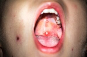 Gingivostomatitis hos børn: Hvad det er, og hvad man kan gøre ved det