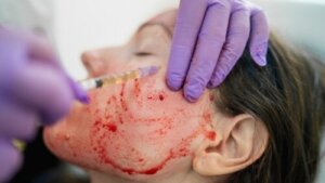 Vampyransigtsløft: Hvad er det, og hvad er risikoen?