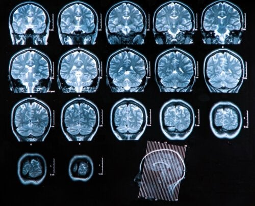 Hjerneabsces: Diagnostik og behandling