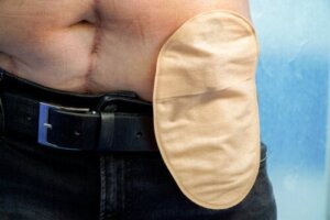 Tips til det daglige liv med stomi