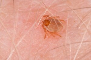Rocky Mountain spotted fever: Symptomer og behandlinger
