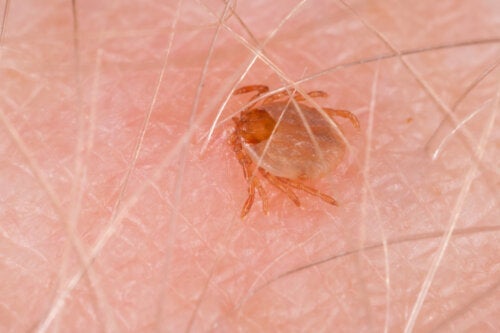 Rocky Mountain spotted fever: Symptomer og behandlinger