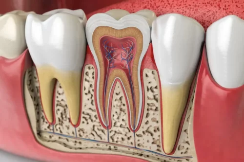 Illustration af ankylose af en tand i munden