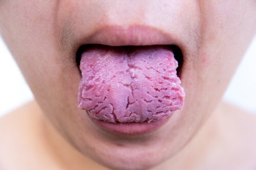 Fissureret tunge: Årsager og behandling