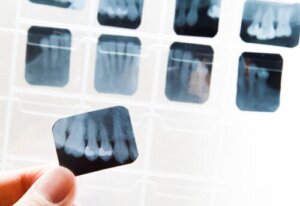 Hvad er ankylose af en tand, og hvordan kan det behandles?