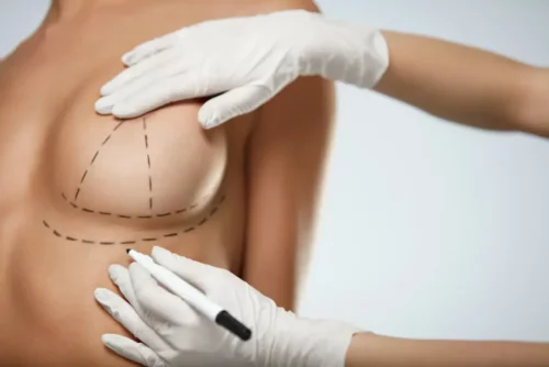 Tegning på en kvindes krop før et brystløft