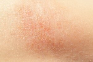 7 naturlige midler mod tør hud