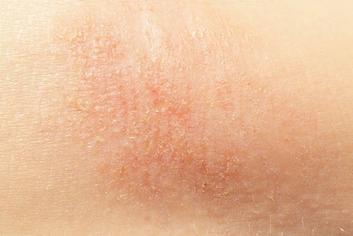 6 naturlige midler mod tør hud