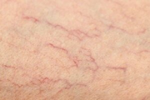 5 naturlige midler mod karsprængninger på benene
