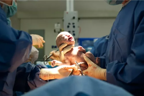 Nyfødt baby efter kejsersnit