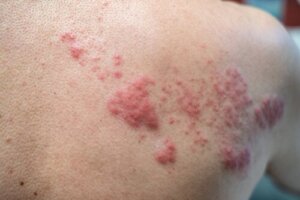 90 % af spanierne bærer varicella-zoster virus